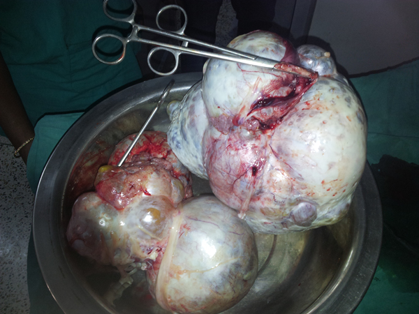 Tubal reconstructive surgery in Kolkata